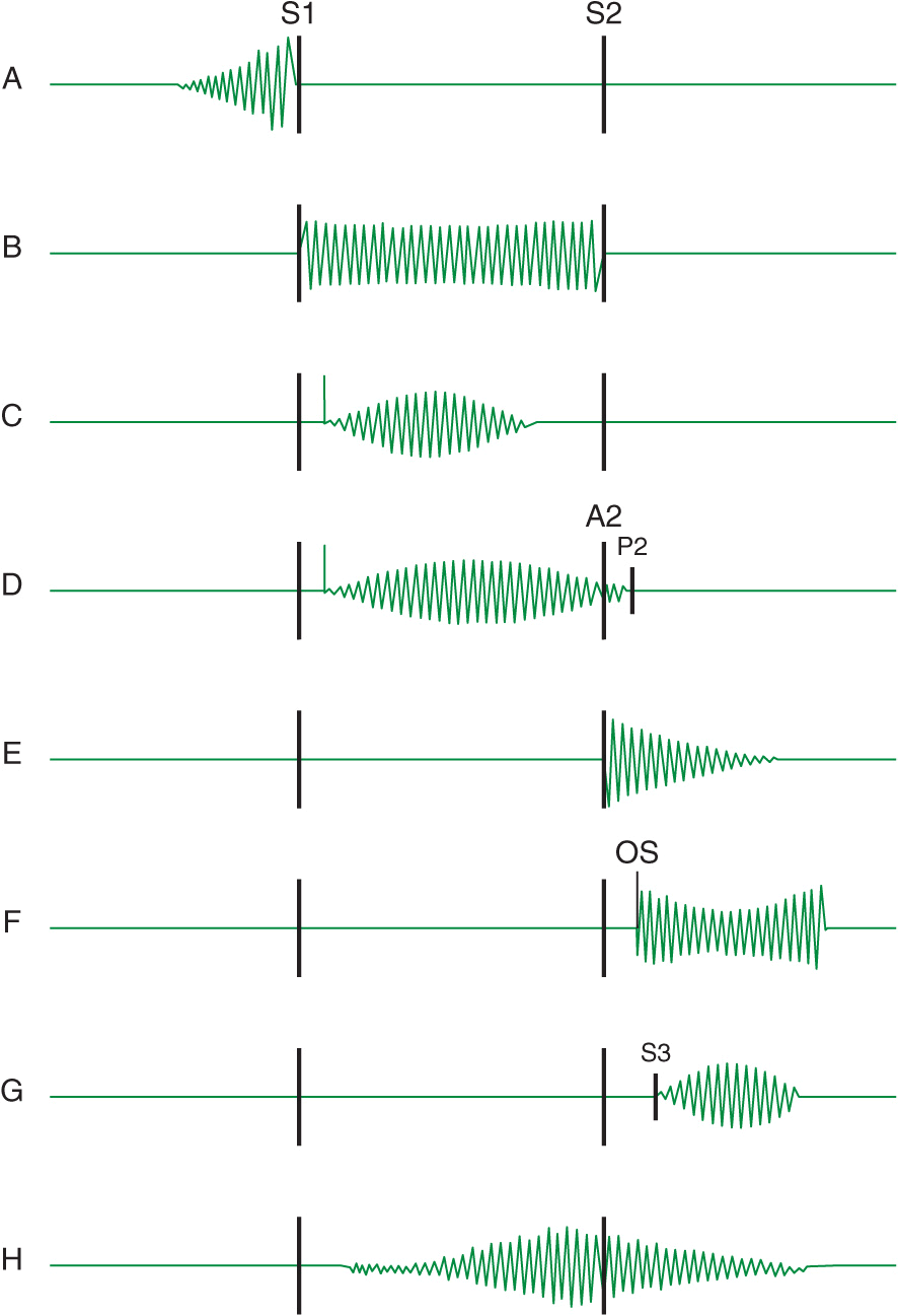 Diagram Of Heart Murmurs Images - How To Guide And Refrence