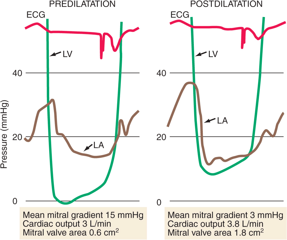 Valvular Heart Disease | Thoracic Key