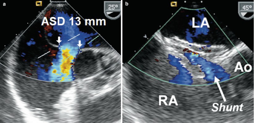 Transesophageal Echocardiography in Adults with Congenital Heart ...