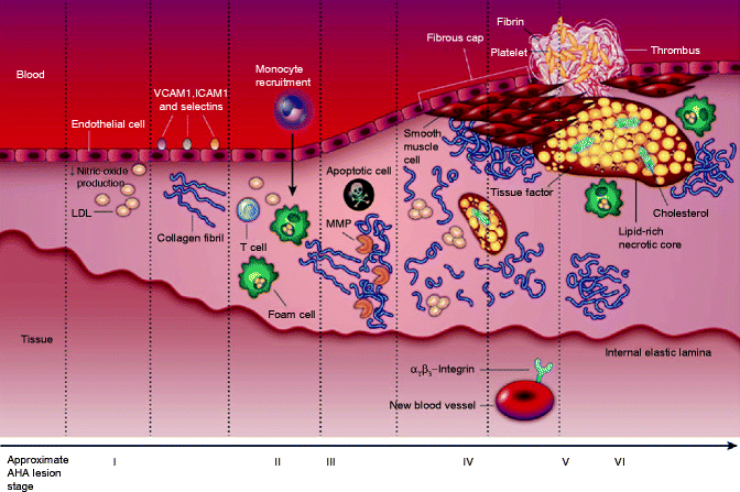 Clinical Manifestations Of Atherothrombosis | Thoracic Key