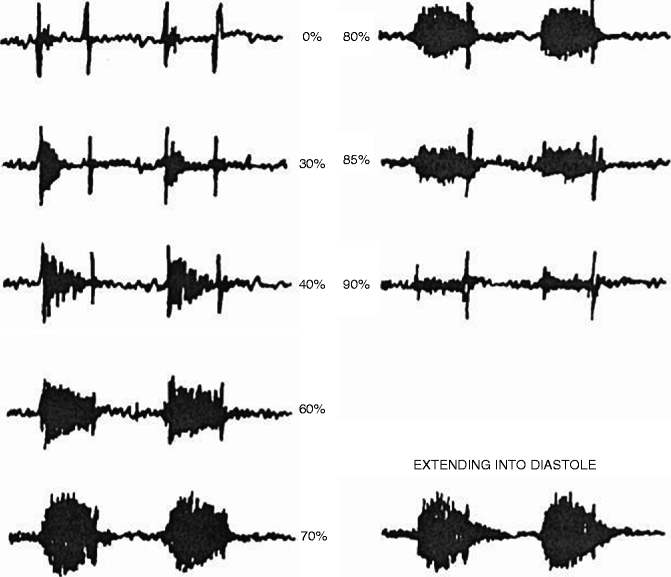 Auscultation And Atherosclerosis Thoracic Key