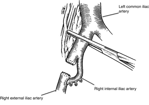 right common iliac artery