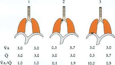 pulmonary embolism dead space ventilation