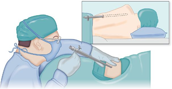 Diagnostic Thoracic Surgical Procedures Thoracoscopy Vats And Thoracotomy Thoracic Key 