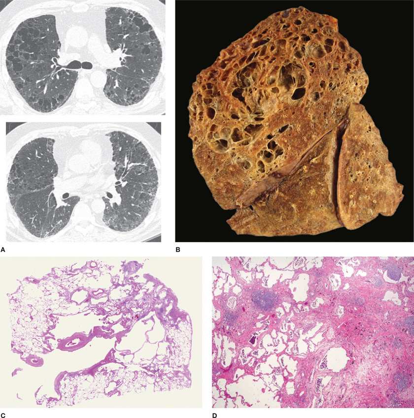 chronic bronchitis histology