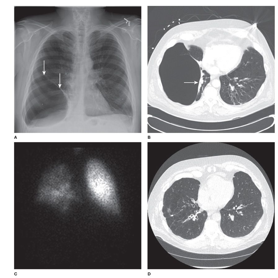 Bullous Disease Of The Lung Thoracic Key