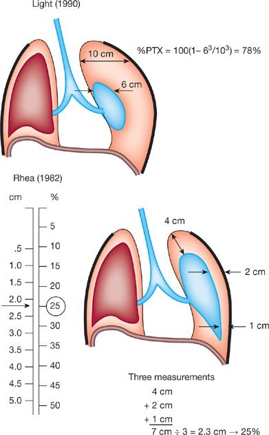 spontaneous pneumothorax tracheal deviation