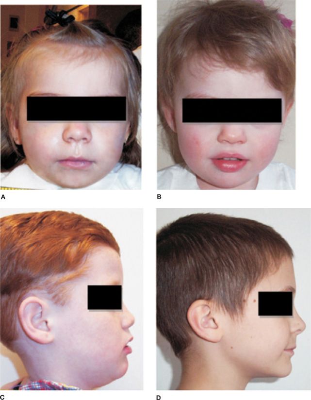 Congenital central hypoventilation syndrome что это