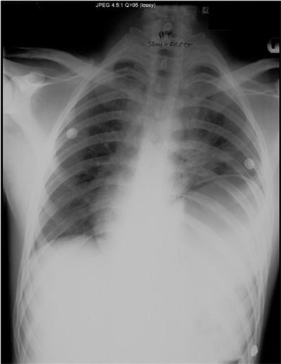 Thoracic Trauma | Thoracic Key