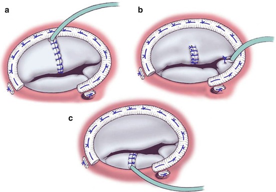 Surgical Techniques Of Tricuspid Valve Repair In Patients Without ...