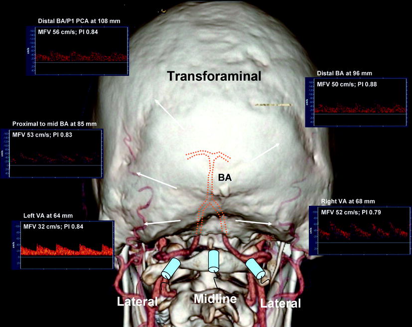 transcranial doppler training courses