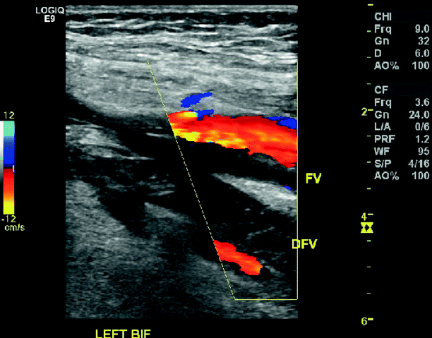 Venous Duplex Ultrasound Of The Lower Extremity In The Diagnosis Of ...