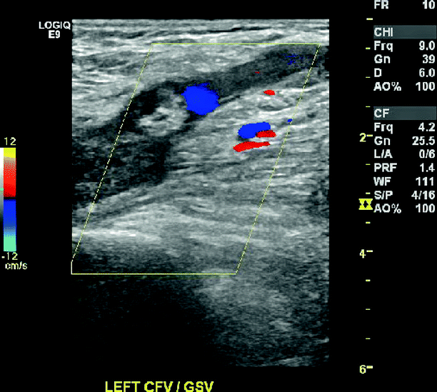Lower Extremity Venous Ultrasound