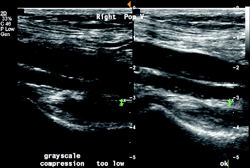 Principles Of Vascular Ultrasound Physics Thoracic Key