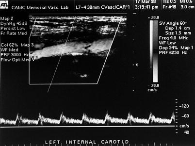 Duplex Scanning of the Extracranial Carotid Arteries | Thoracic Key