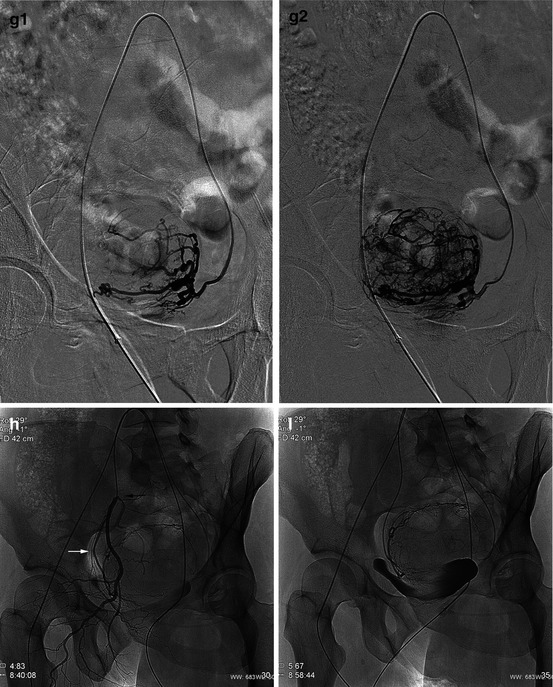 Uterine Fibroid Embolization Ufe Thoracic Key