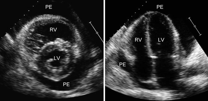 Pericardial Window | Thoracic Key