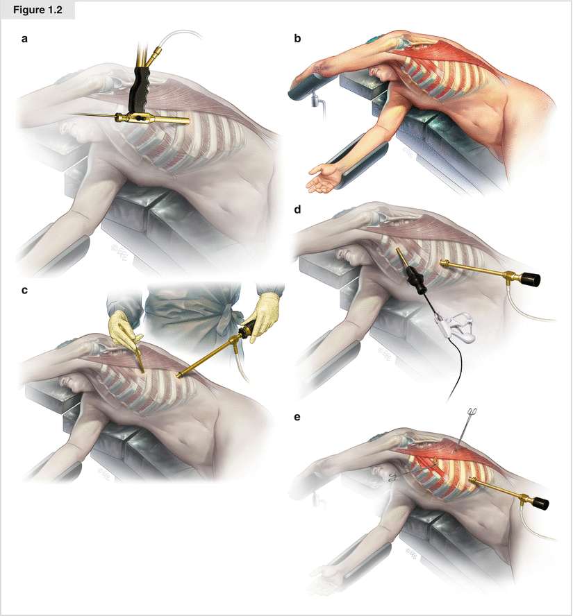 Video Assisted Thoracoscopic Surgery Thoracic Key 