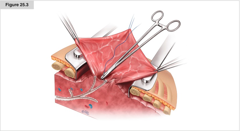 Bullectomy | Thoracic Key