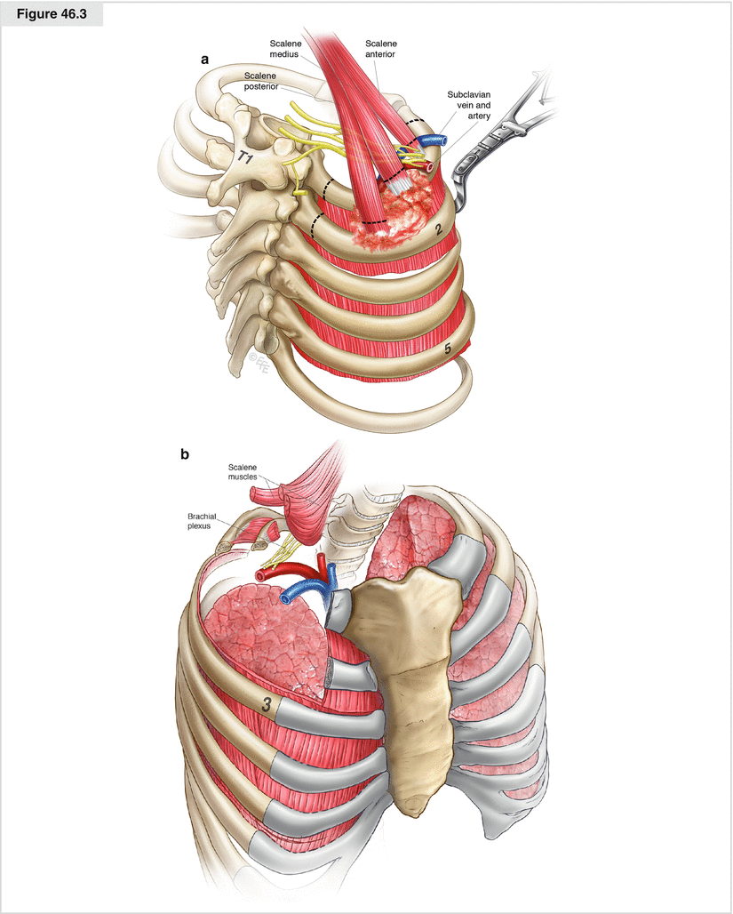 superior-pulmonary-sulcus-pancoast-tumors-thoracic-key