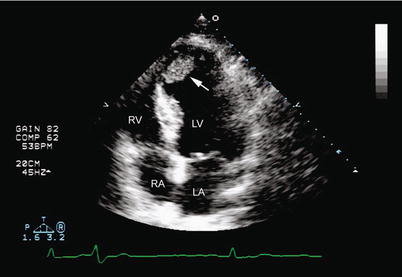 Echocardiographic Evaluation of Coronary Artery Disease | Thoracic Key