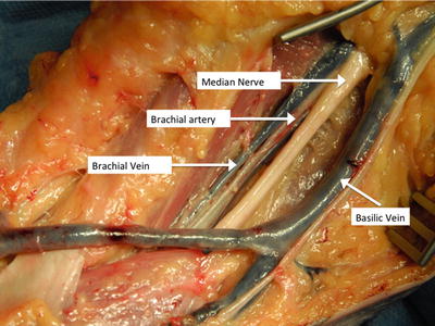 Frontiers  Vascular Shunts in Civilian Trauma