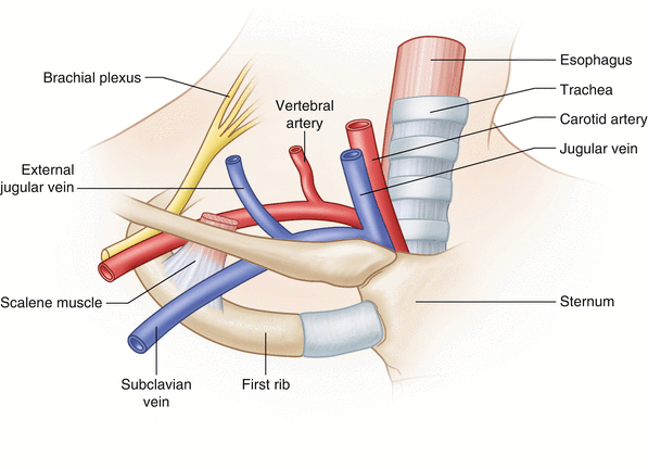 central line catheter jugular