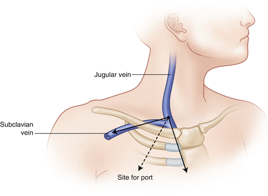 external jugular vein line placement