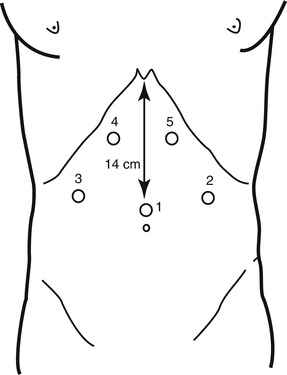 Minimally Invasive Treatment of GERD | Thoracic Key