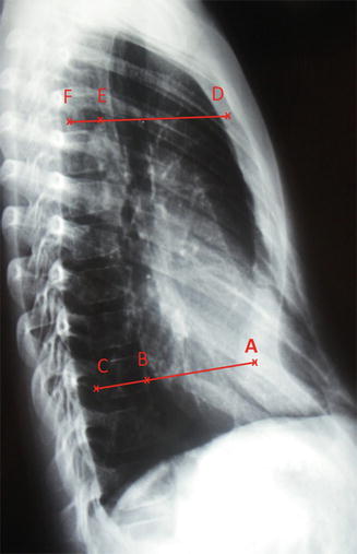 pectus excavatum x ray