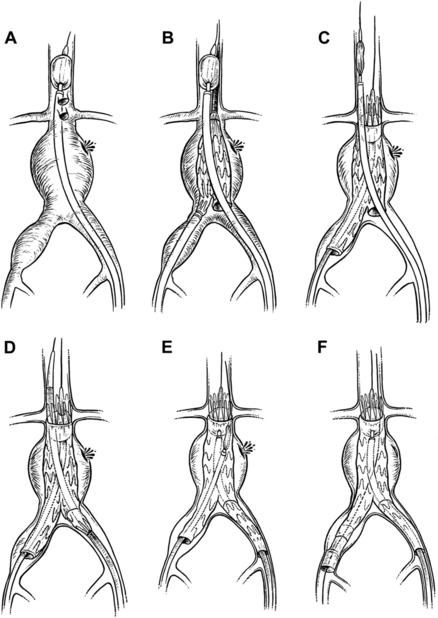 of supraceliac balloon control of the aorta during endovascular repair ...