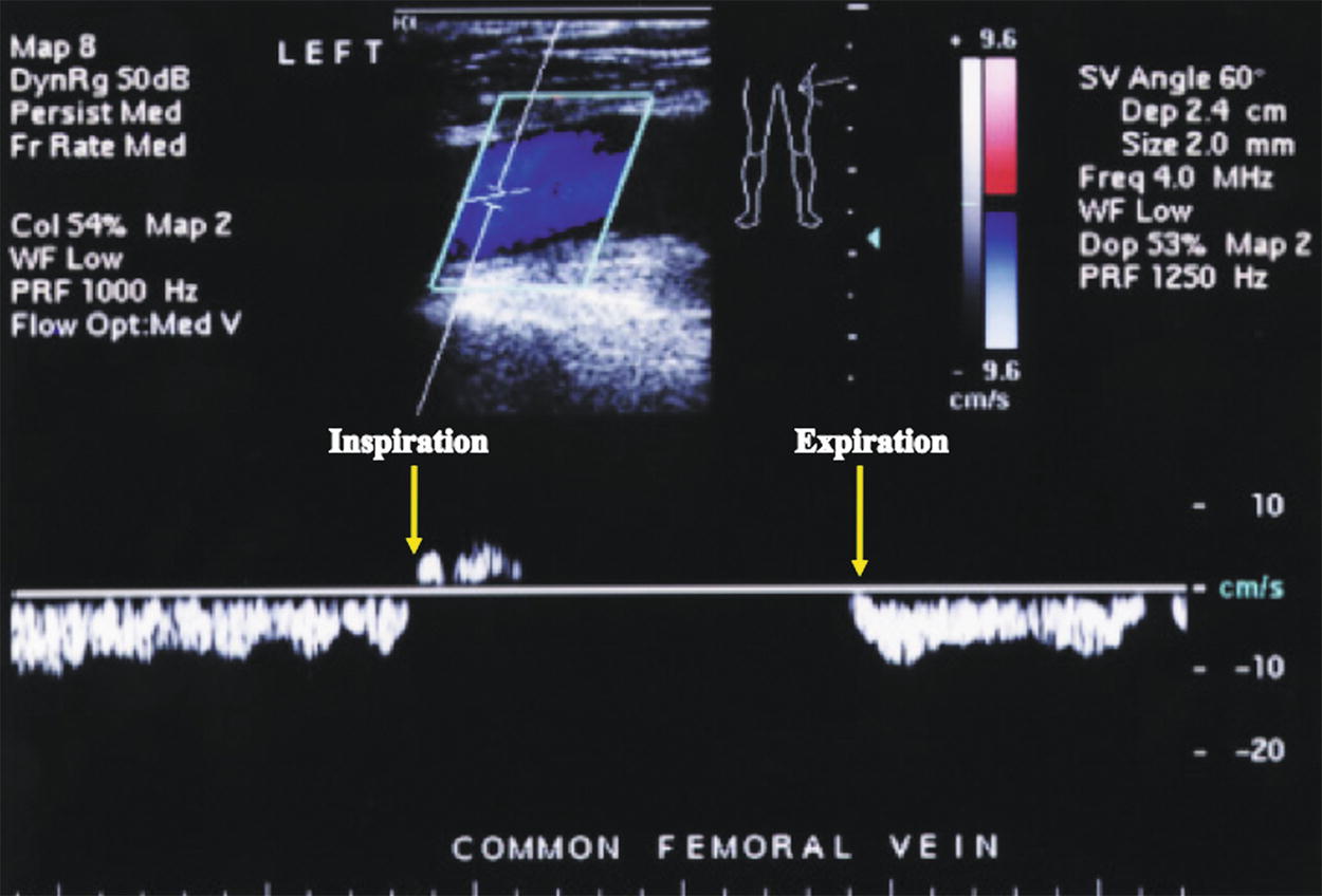 Effect of the Foot and Ankle Exercise on Blood Flow Velocity of the Common  Femoral Vein in Patients with Hip Fracture