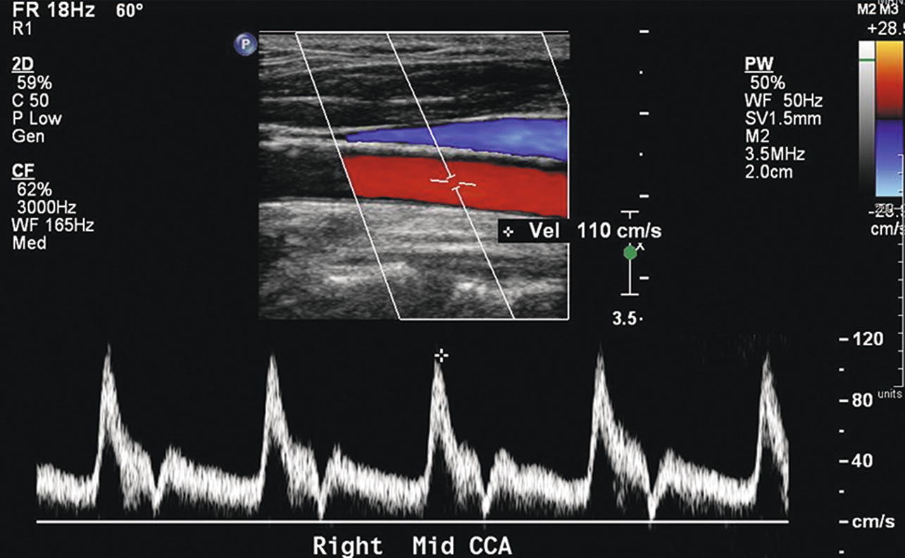 extracranial-carotid-and-vertebral-arteries-thoracic-key