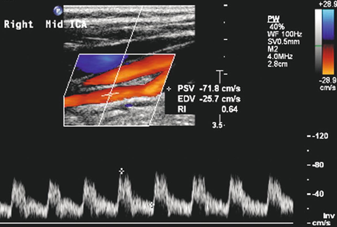 Carotid Ultrasound Waveforms