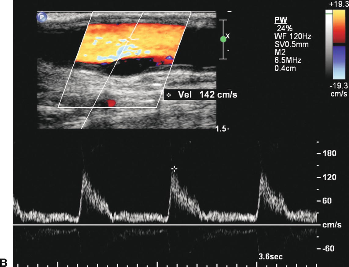 Follow-Up after Carotid Endarterectomy and Stenting | Thoracic Key