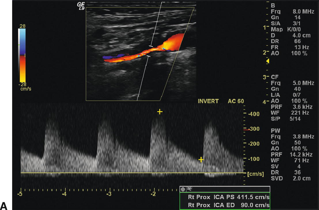 Follow-Up after Carotid Endarterectomy and Stenting | Thoracic Key