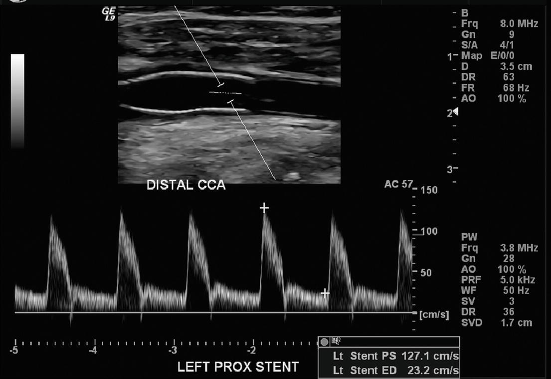 Carotid Endarterectomy Ultrasound