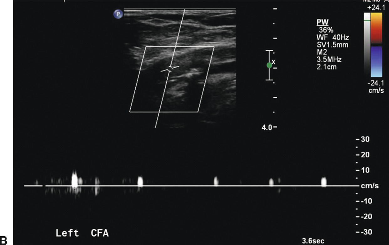 Duplex Assessment Of Lower Limb Arterial Disease Radi