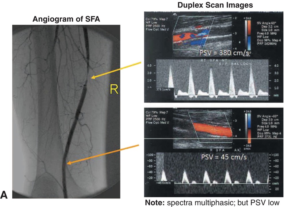 Surveillance after Peripheral Artery Endovascular Intervention ...