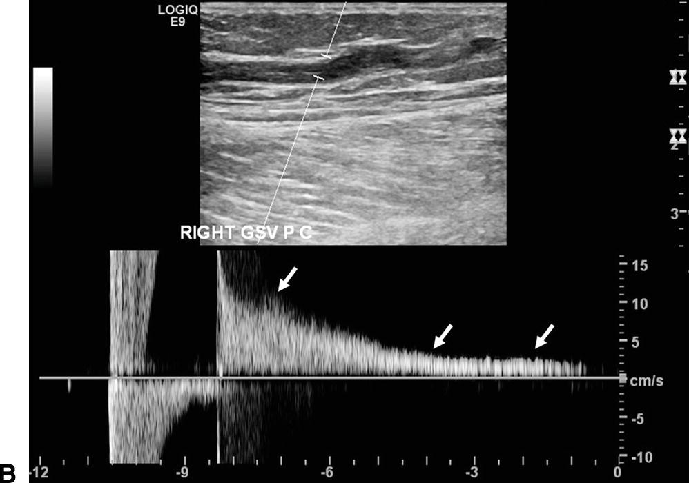 venous reflux ultrasound