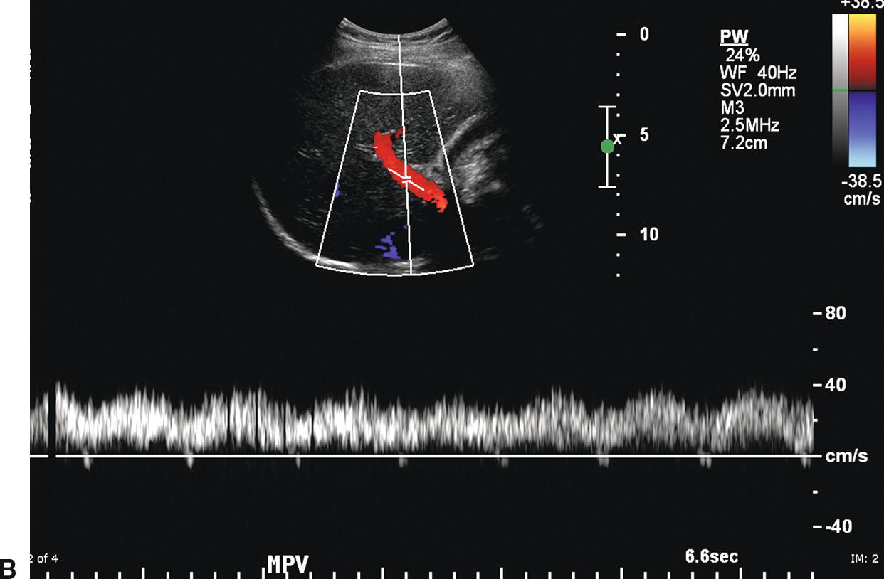 Normal Portal Vein Ultrasound