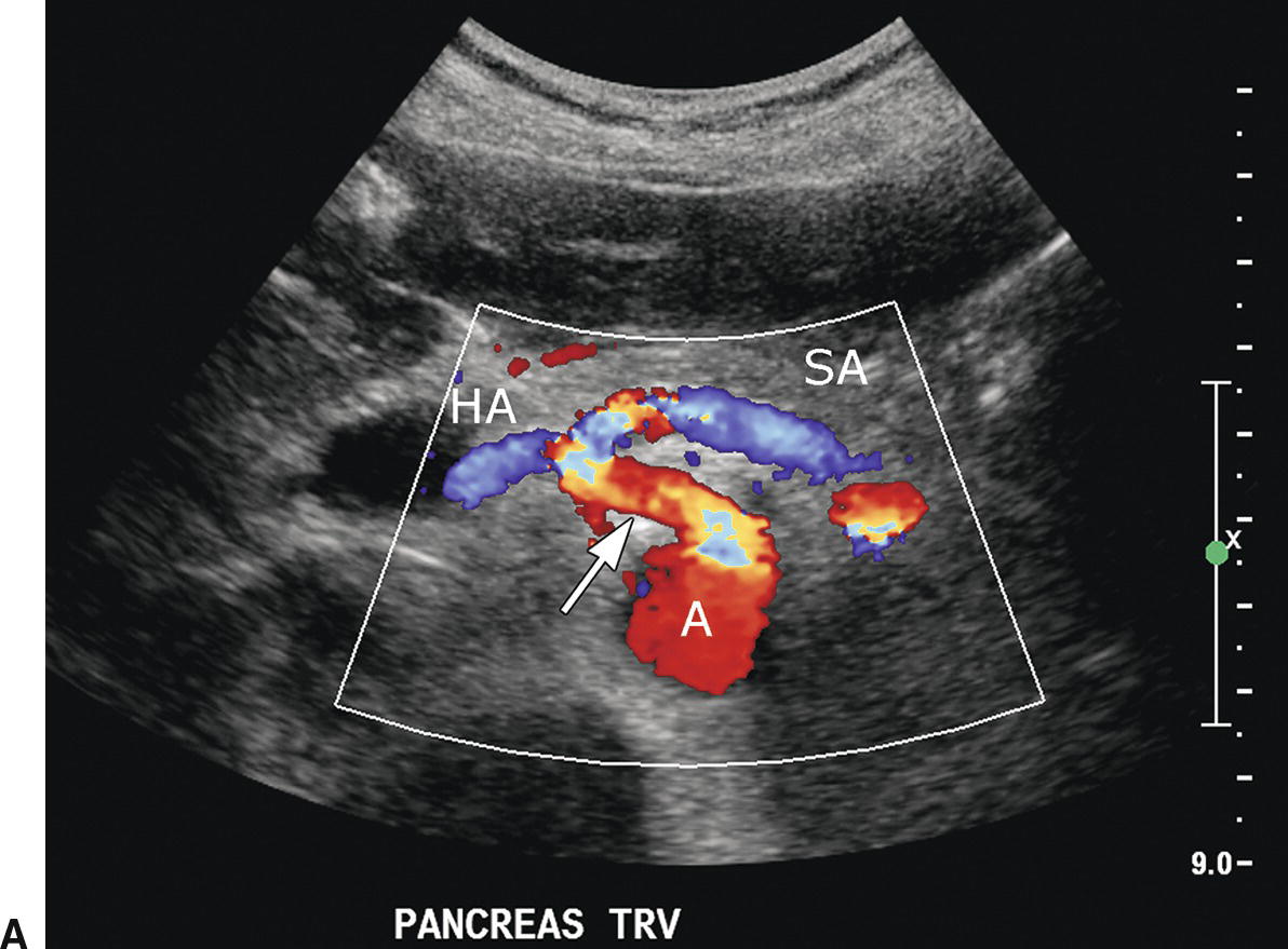 superior mesenteric vein ultrasound