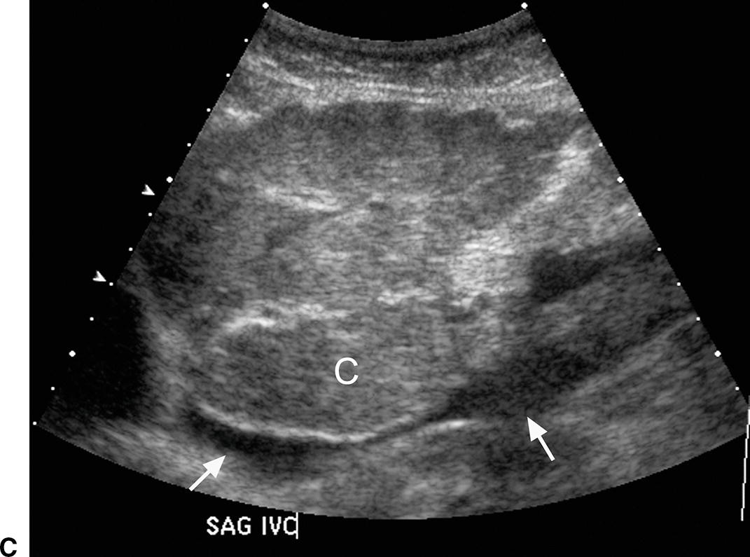 caudate lobe of liver ultrasound