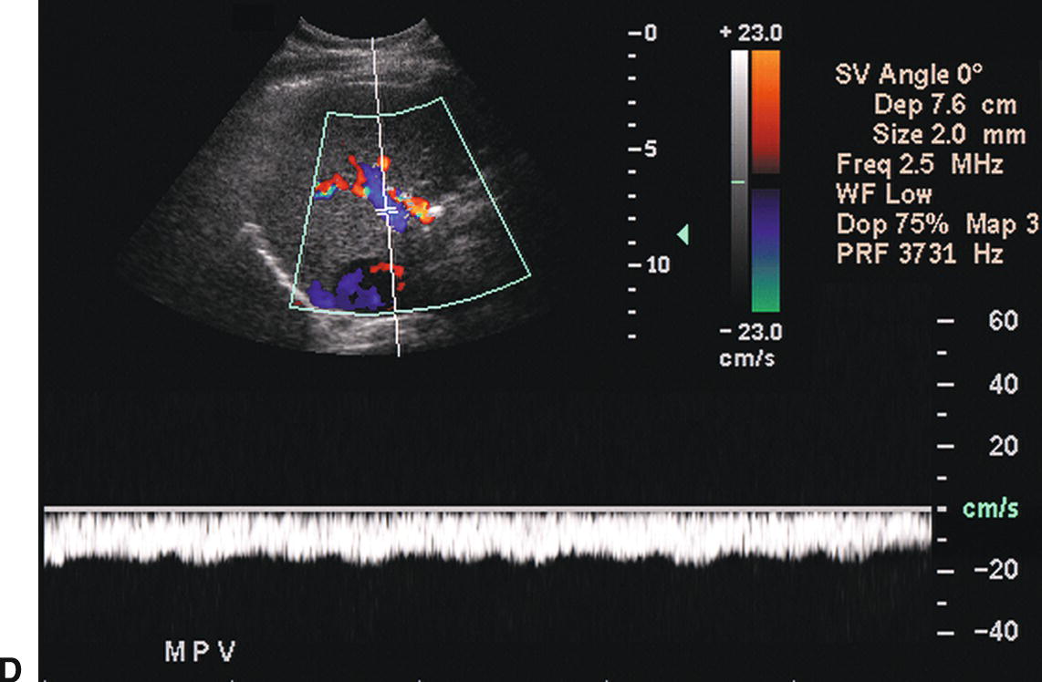 paraumbilical vein ultrasound