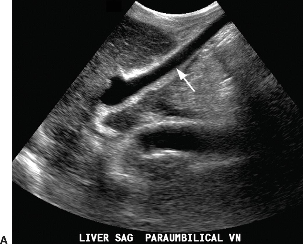 paraumbilical vein ultrasound