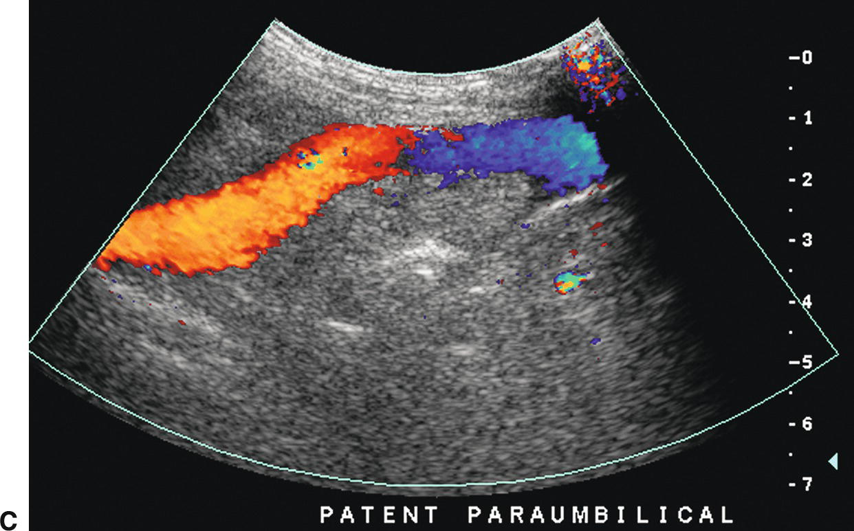 paraumbilical vein ultrasound