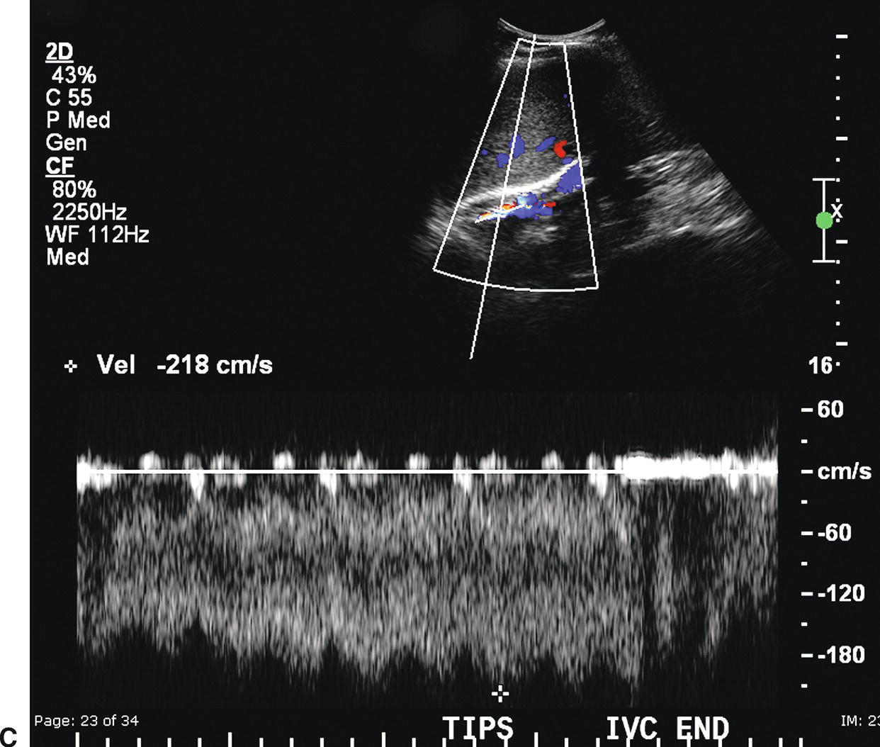 TIPS Shunt Ultrasound