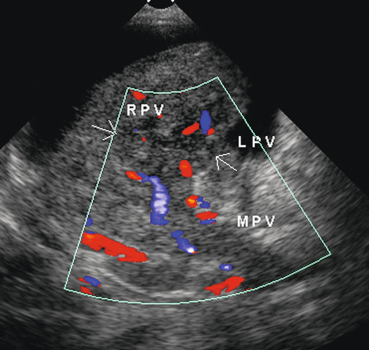 Right And Left Portal Vein Ultrasound