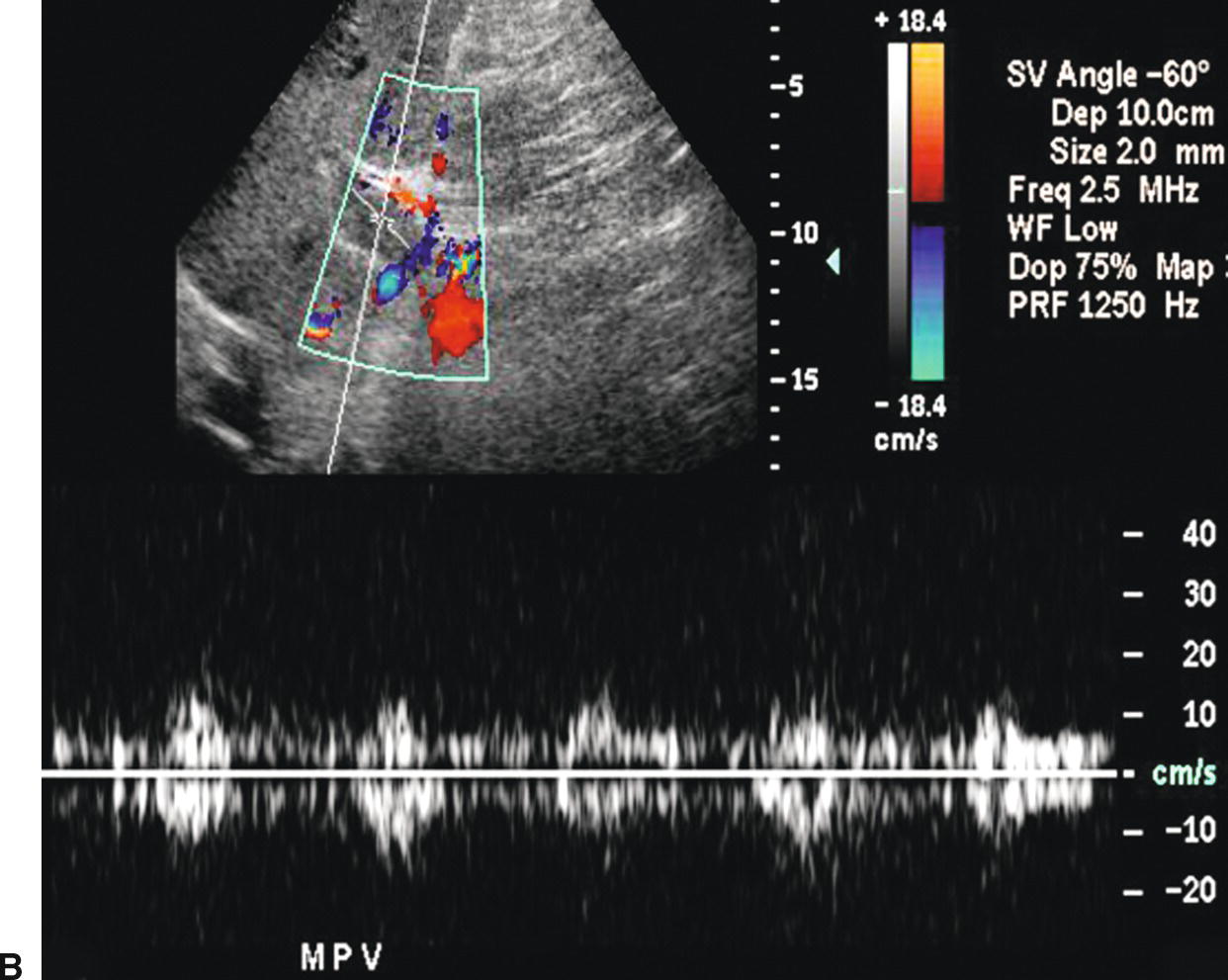 Hepatofugal Flow Ultrasound