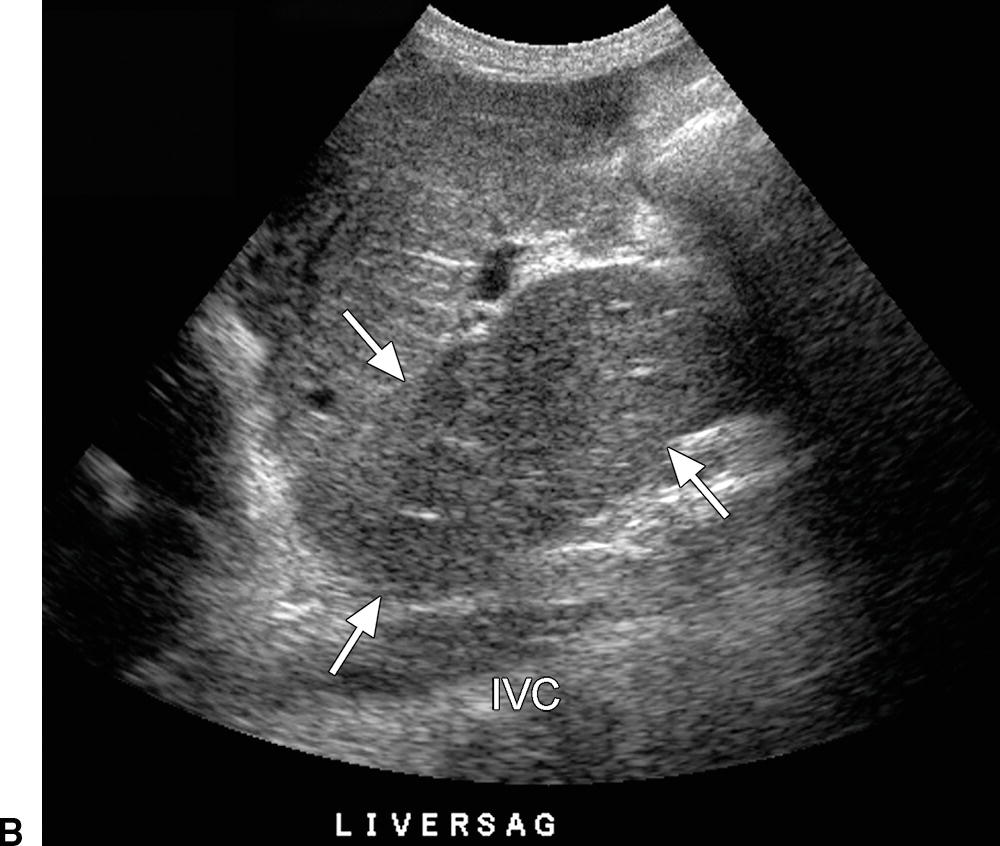 caudate lobe of liver ultrasound